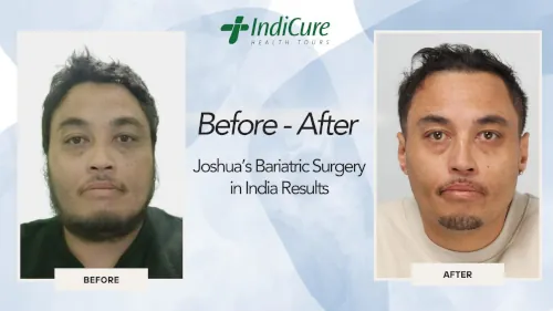 Joshua's Bariatric Surgery Abroad in India Results